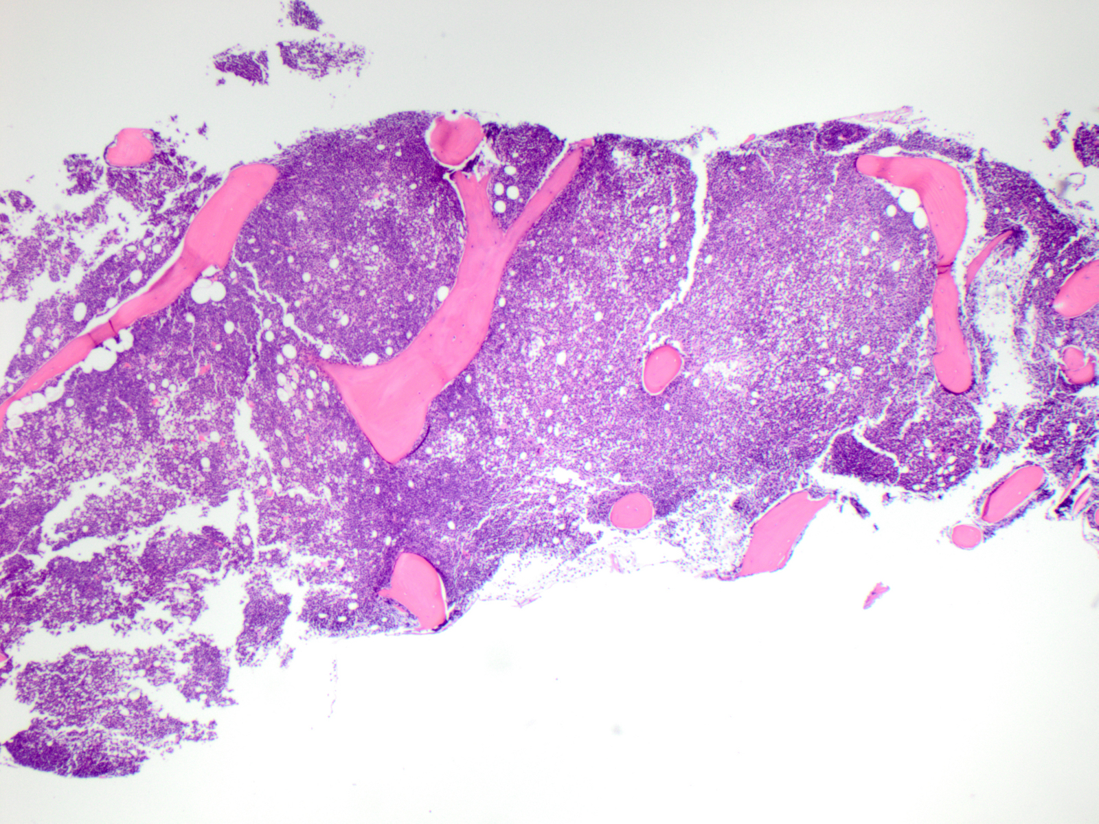 Specimen 1, BM core biopsy, H&E x 40